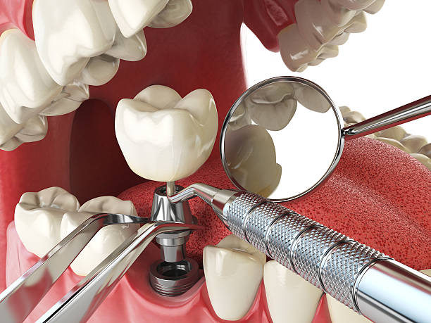 Best Emergency Treatment for Dental Infections or Abscesses in Goleta, CA