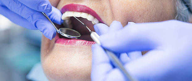 Best Emergency Wisdom Teeth Removal in Goleta, CA
